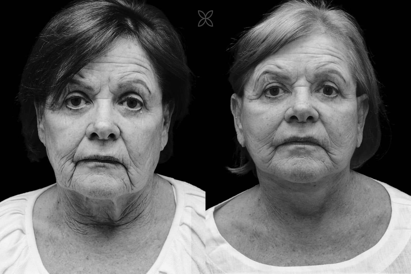Facelift & neck lift — before and after