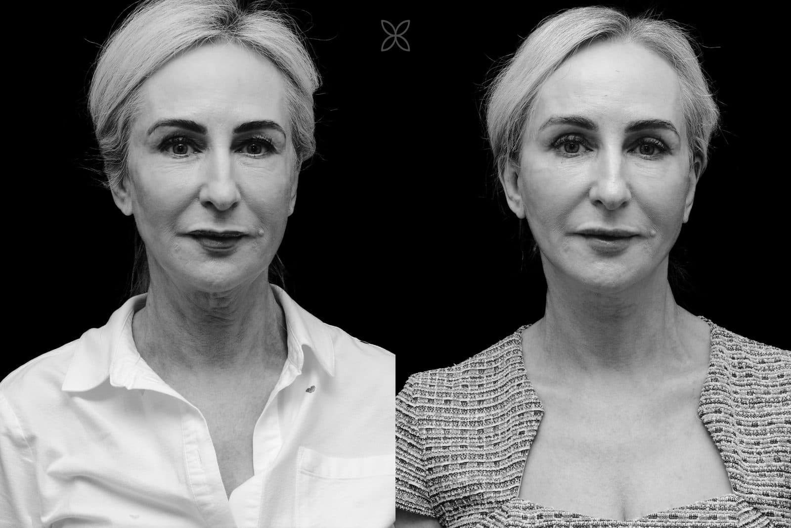 Facelift & neck lift — before and after