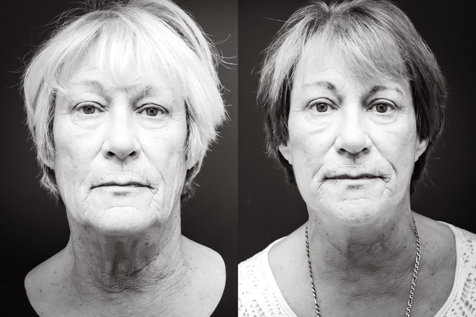Facelift & neck lift — before and after
